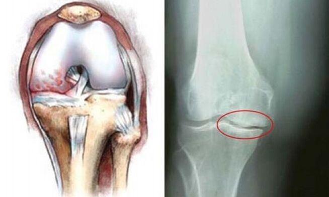 artróza kolena röntgen