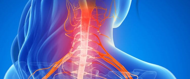 Kompresia ciev miechy pri osteochondróze krčnej chrbtice