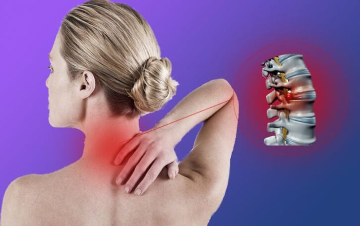 Osteochondróza krčnej chrbtice vedie k rozvoju intervertebrálnych hernií