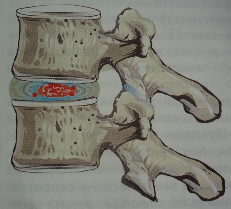 Poškodenie nucleus pulposus medzistavcovej platničky v prvom štádiu cervikálnej osteochondrózy