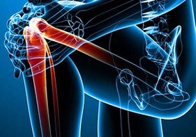 bolesť kolena s artritídou a artrózou