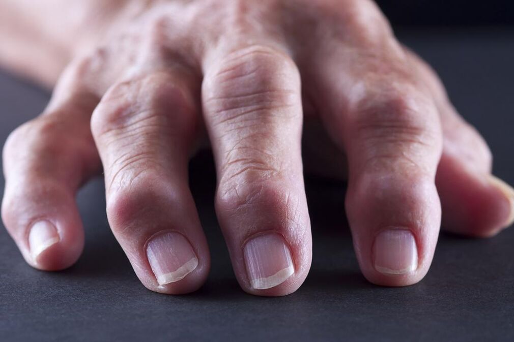 Burzitída je charakterizovaná bolesťou, zápalom a opuchom kĺbov prstov