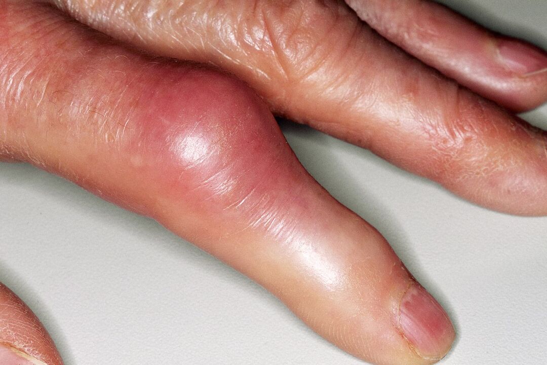 Opuch, deformácia kĺbu prsta a akútna bolesť po úraze