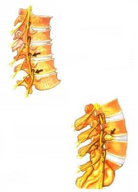 ilustrácia spinálnej osteochondrózy